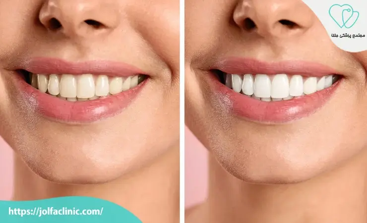 تفاوت بلیچینگ با جرم گیری و کامپوزیت