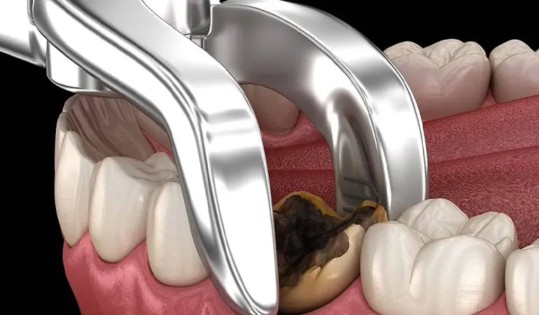 عصب کشی دندان