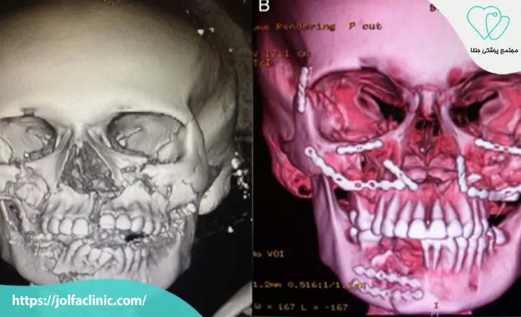 جراحی کیست ها و تومورهای فکی