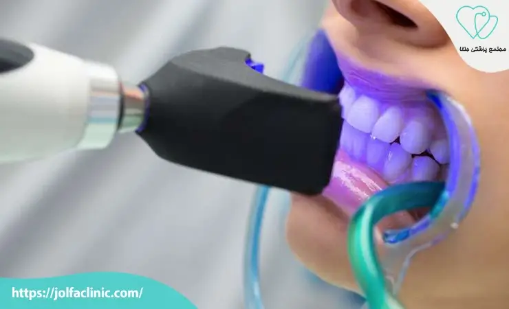 انواع بلیچینگ دندان