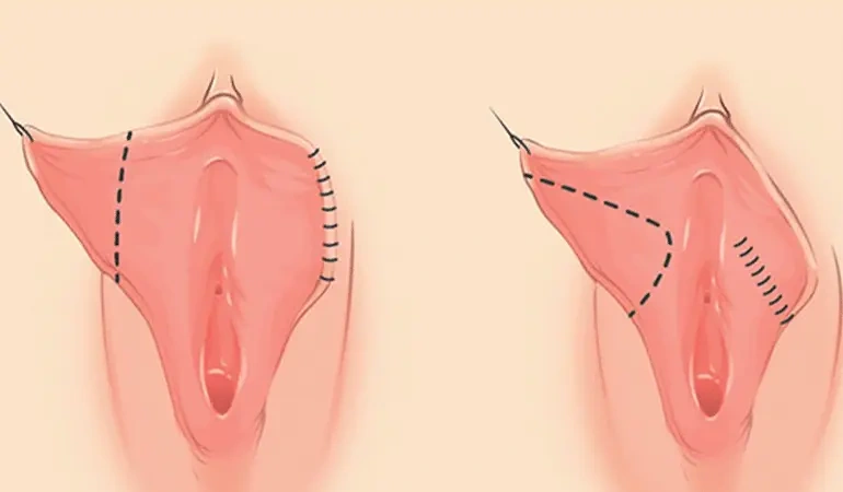 عمل زیبایی واژن(لابیاپلاستی)