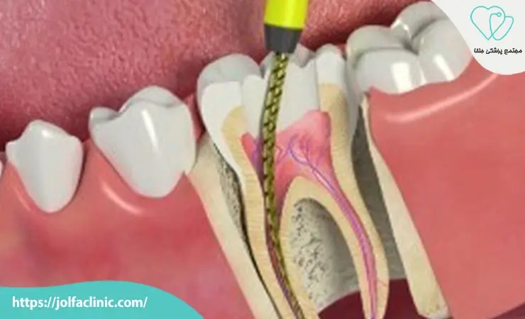 چرا دندان نیاز به عصب کشی دندان پیدا می کند؟