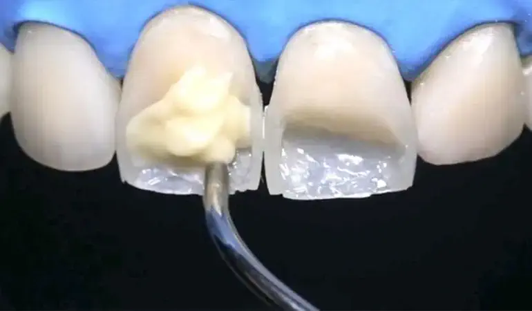 کامپوزیت دندان